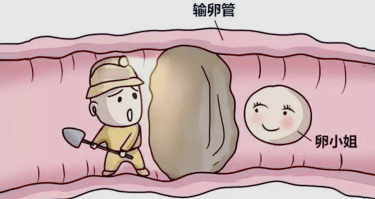 如何處理輸卵理擠塞