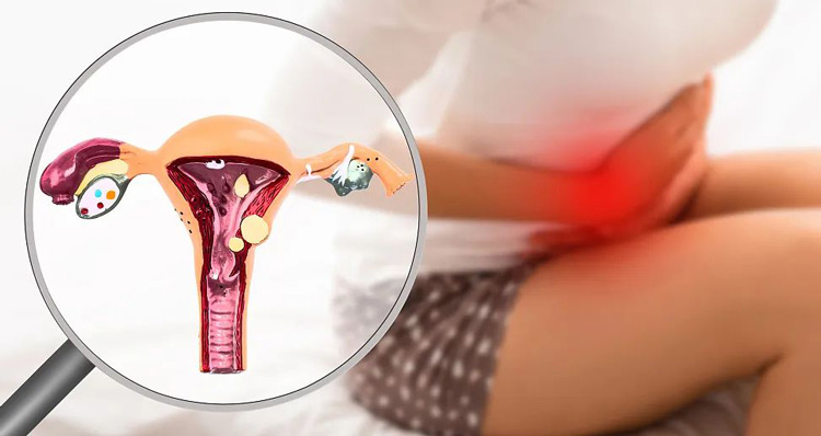 子宮內膜異位症 子宮內膜異位症