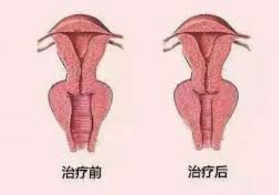 長時間沒有性生活陰道會變緊嗎?