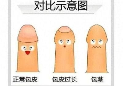 割包皮後幾時可以返工?香港后生仔实测指南来啦!