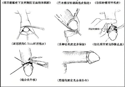 25248308.jpg 包皮過長影響