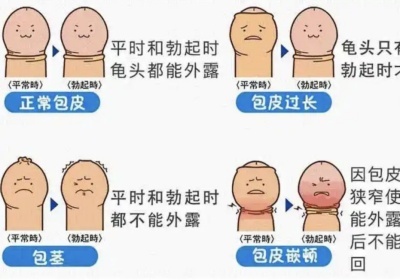 51674993.jpg 包皮過長影響